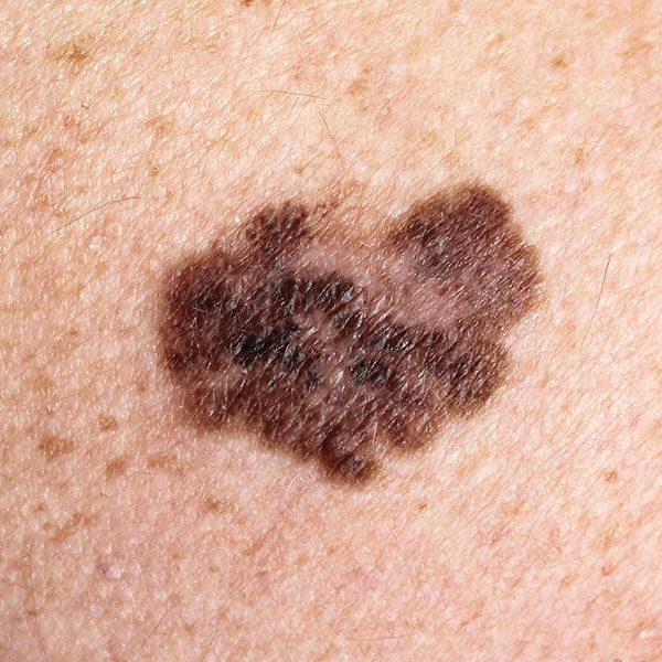 melanoma